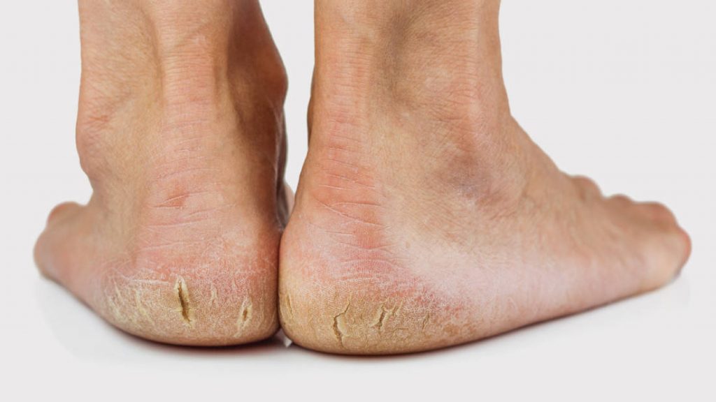 Cracked Heels