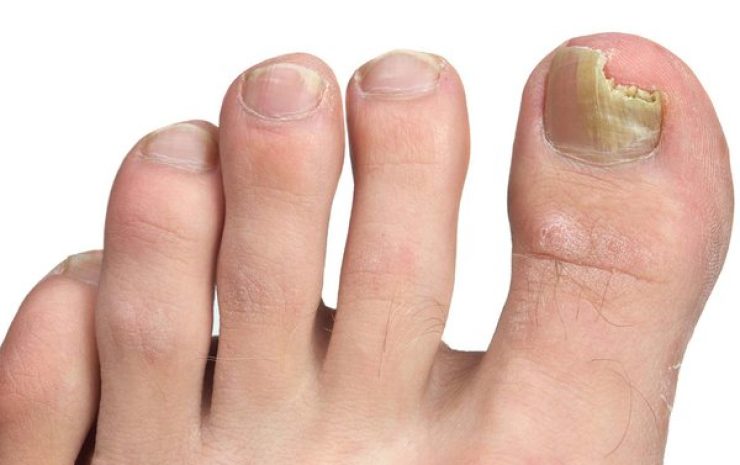 Fungal Toenail